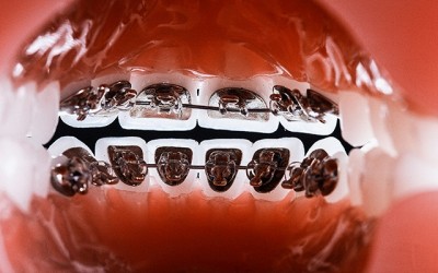 Implant dentar
