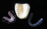 inserare implant dentar