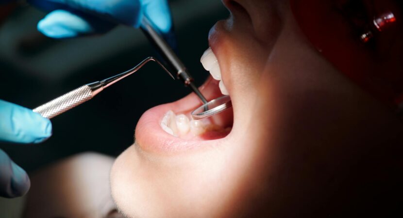 Cancerul oral